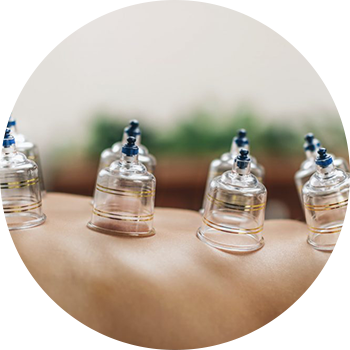 Cupping-Therapy