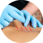 Dry-Needling