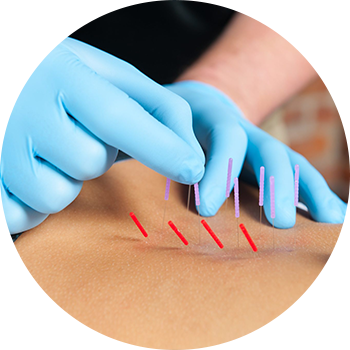 Dry-Needling